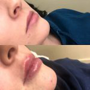 Before and After Image of Lip Filler at Noor Laser Center in Catonsville MD Before and After Image of Lip Filler at Noor Laser Center in Catonsville MD