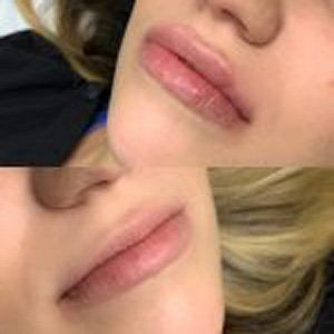 Before and After Image of Lip Filler at Noor Laser Center in Catonsville MD Before and After Image of Lip Filler at Noor Laser Center in Catonsville MD