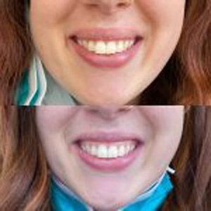Before and After Image of Botox at Noor Laser Center in Catonsville MD Before and After Image of Botox at Noor Laser Center in Catonsville MD