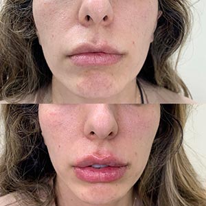Before and After Image of Lip Filler at Noor Laser Center in Catonsville MD Before and After Image of Lip Filler at Noor Laser Center in Catonsville MD