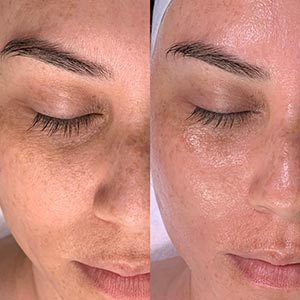 Before and After Image of Hydrafacial at Noor Laser Center in Catonsville MD Before and After Image of Hydrafacial at Noor Laser Center in Catonsville MD