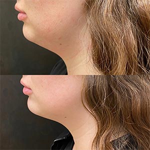 Before and After Image of Kybella at Noor Laser Center in Catonsville MD Before and After Image of Kybella at Noor Laser Center in Catonsville MD