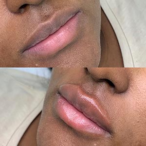 Before and After Image of Lip Filler at Noor Laser Center in Catonsville MD Before and After Image of Lip Filler at Noor Laser Center in Catonsville MD