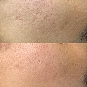 Before and After Image of Microneedling at Noor Laser Center in Catonsville MD Before and After Image of Microneedling at Noor Laser Center in Catonsville MD