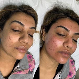 Before and After Image of Microneedling at Noor Laser Center in Catonsville MD Before and After Image of Microneedling at Noor Laser Center in Catonsville MD