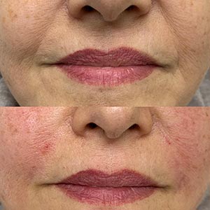 Before and After Image of Nasolabial Fold Filler at Noor Laser Center in Catonsville MD Before and After Image of Nasolabial Fold Filler at Noor Laser Center in Catonsville MD