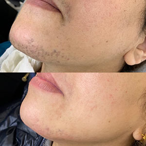 Before and After Image of Laser Hair Removal at Noor Laser Center in Catonsville MD Before and After Image of Laser Hair Removal at Noor Laser Center in Catonsville MD
