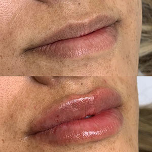 Before and After Image of Lip Filler at Noor Laser Center in Catonsville MD Before and After Image of Lip Filler at Noor Laser Center in Catonsville MD