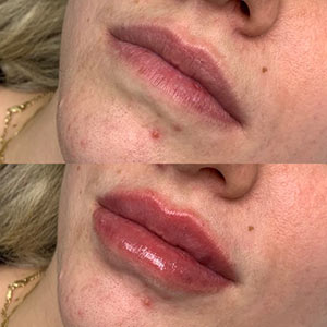 Before and After Image of Lip Filler at Noor Laser Center in Catonsville MD Before and After Image of Lip Filler at Noor Laser Center in Catonsville MD