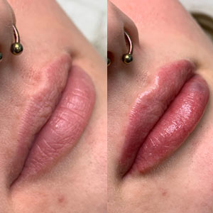 Before and After Image of Lip Filler at Noor Laser Center in Catonsville MD Before and After Image of Lip Filler at Noor Laser Center in Catonsville MD