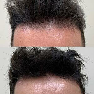 Before and After Image of Hair Restoration at Noor Laser Center in Catonsville MD Before and After Image of Hair Restoration at Noor Laser Center in Catonsville MD