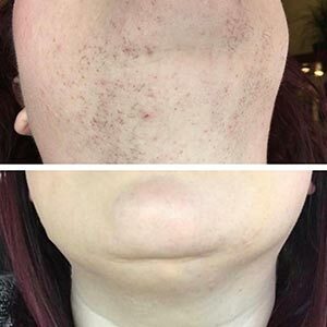 Before and After Image of Laser Hair Removal at Noor Laser Center in Catonsville MD Before and After Image of Laser Hair Removal at Noor Laser Center in Catonsville MD