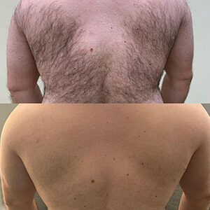 Before and After Image of Laser Hair Removal at Noor Laser Center in Catonsville MD Before and After Image of Laser Hair Removal at Noor Laser Center in Catonsville MD