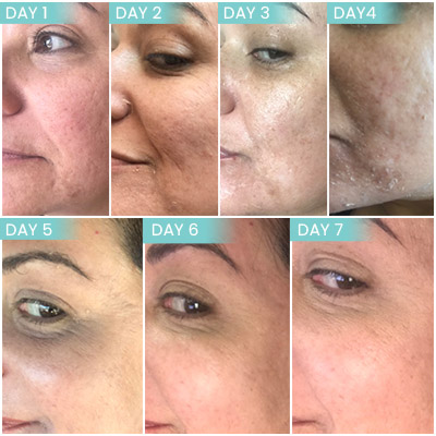 Images of Perfect Derma Peel Treatment at Noor Laser Center in Columbia and Catonsville MD