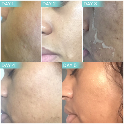 Images of Perfect Derma Peel Treatment at Noor Laser Center in Columbia and Catonsville MD