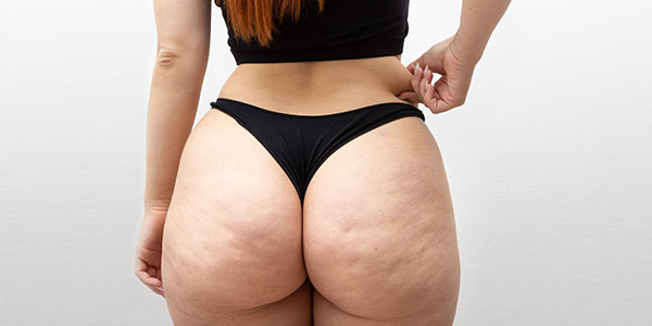 Cellulite Treatment Technology: The Latest Innovations