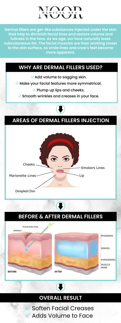 There are several advantages to using dermal fillers for people looking to seem more youthful. They can reduce fine lines and wrinkles, giving your skin a more youthful and smooth appearance. To enhance facial features and contours, fillers can also increase volume in places like the lips and cheeks. Emily, RN, our registered nurse, has a great deal of knowledge about figuring out the right injection site and dose to produce the most gorgeous outcomes. For more information, contact us or request an appointment online. We are conveniently located at 700 Geipe Road Suite 100 Catonsville, MD 21228.