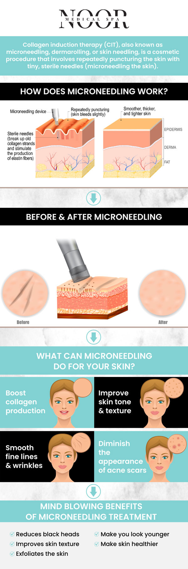 Microneedling with VAMP combines the benefits of microneedling and advanced platelet-rich plasma therapy to rejuvenate skin, reduce fine lines, and improve texture. This treatment promotes natural collagen production for a smoother, more youthful appearance. For more information, contact us or request an appointment online. We are conveniently located at 700 Geipe Road Suite 100 Catonsville, MD 21228. We serve clients from Catonsville MD, Ellicott City MD, Clarksville MD, Fulton MD, Baltimore MD, Pikesville MD, Woodbine MD, and the surrounding areas.