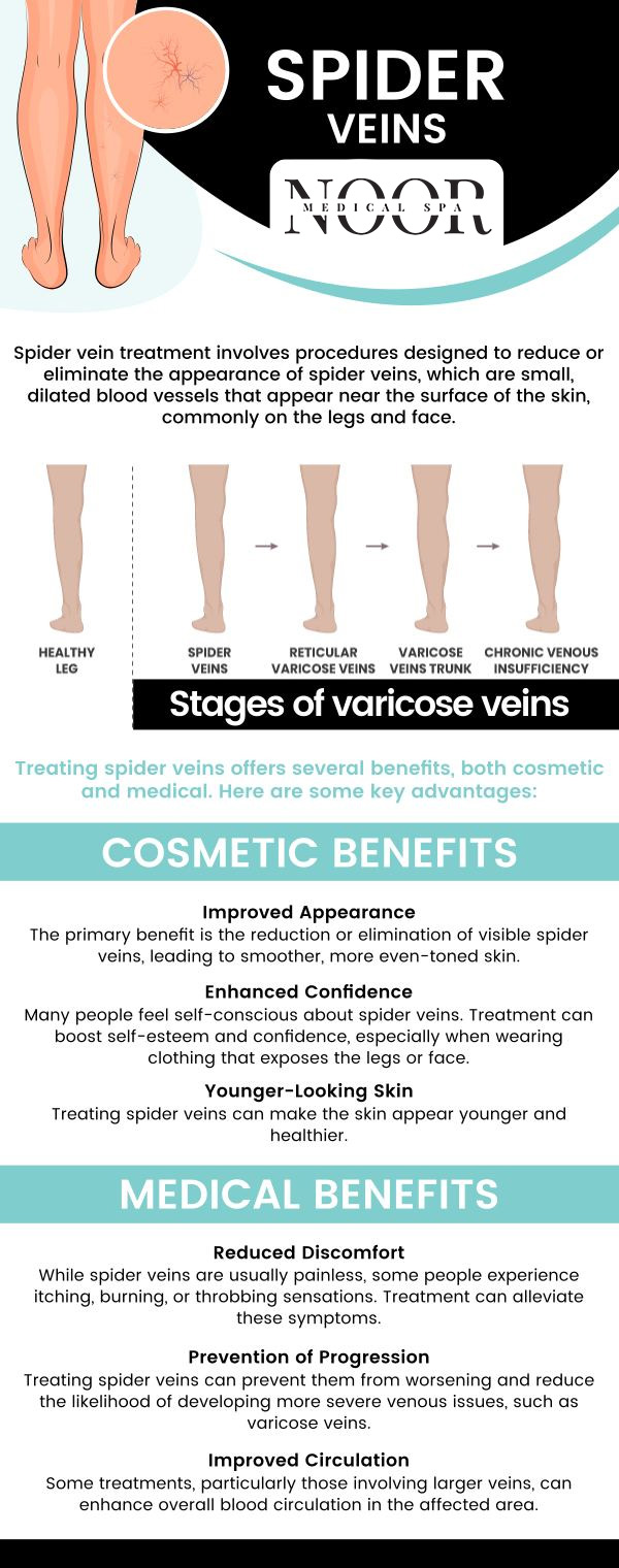 Small, twisted vessels that are red, purple, and blue are called spider veins. Spider veins are also readily discernible through the skin. They impact the capillaries, which are the tiniest blood vessels in the body. The red or blue veins of spiders resemble a tree branch or a spider's web. Usually, they are noticeable on the face and legs. Dr. Nasser Nasseri, MD, provides effective treatment for spider veins at Noor Medical Spa. For more information, contact us today or book an appointment online. We are conveniently located at 700 Geipe Road Suite 100 Catonsville, MD 21228.